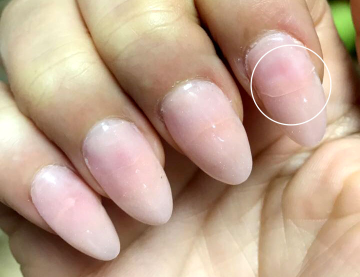 Detalle 17+ imagen dolor por uñas acrilicas